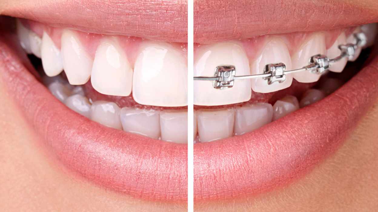 implanty zębów tanio Wrocław