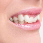 Leczenie choroby okluzyjnej